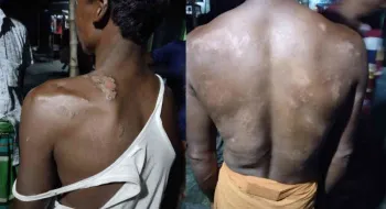 কুড়িগ্রামে পাট কাটতে গিয়ে অজ্ঞাত পোকার কামড়ে অসুস্থ শতাধিক শ্রমিক