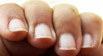 নখে ফুটে ওঠে যেসব রোগের লক্ষণ