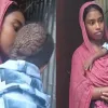 বিরল রোগ সিফাতের মাথা জুড়ে বেঁধেছে বাসা ধীরে ধীরে করছে  গ্রাস